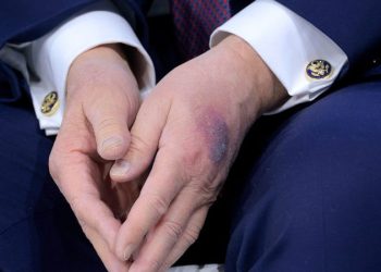 White House explains bruise on Trump’s hand